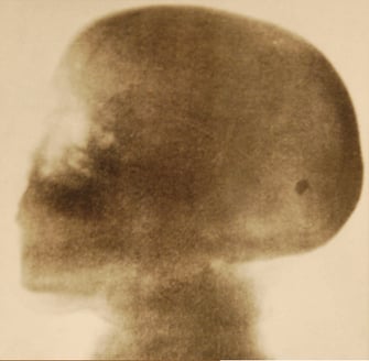Röntgenfotografering av skallen hos doktor Thor Stenbeck i Stockholm den 10 september 1896.